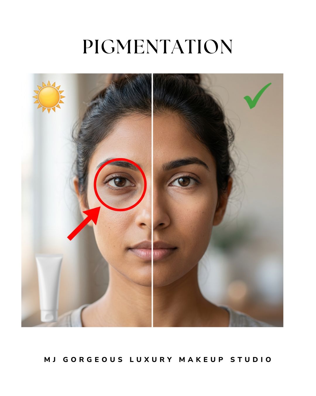 Under-eye pigmentation example brown tone