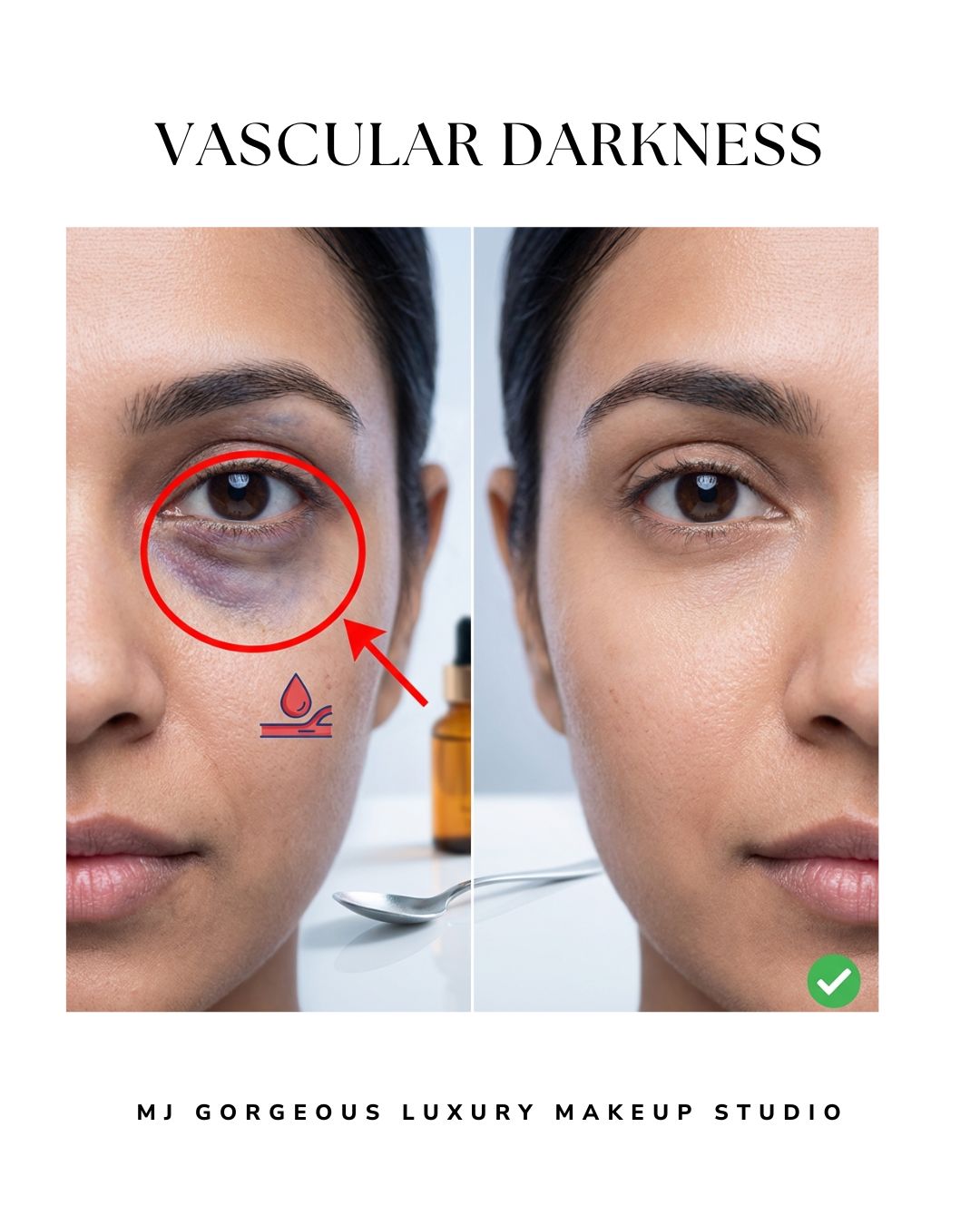 Under-eye vascular darkness blue tone